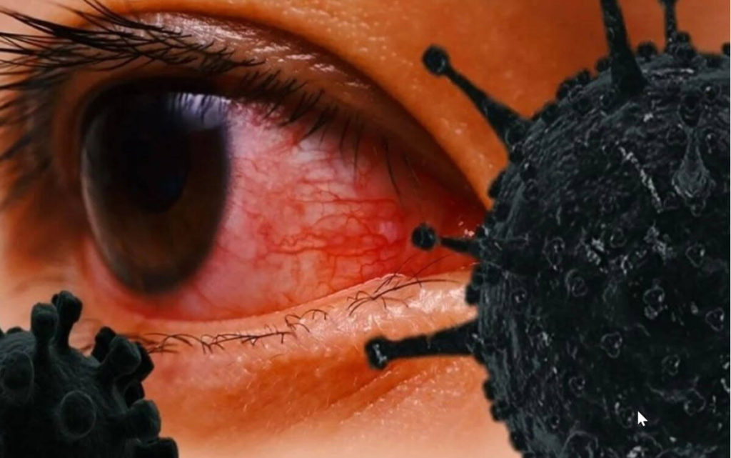 Black Fungus _eye pain & redness.