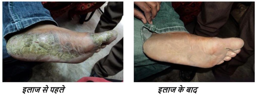 Case study of Ayurvedic_Psoriasis Before and after treatment photos.