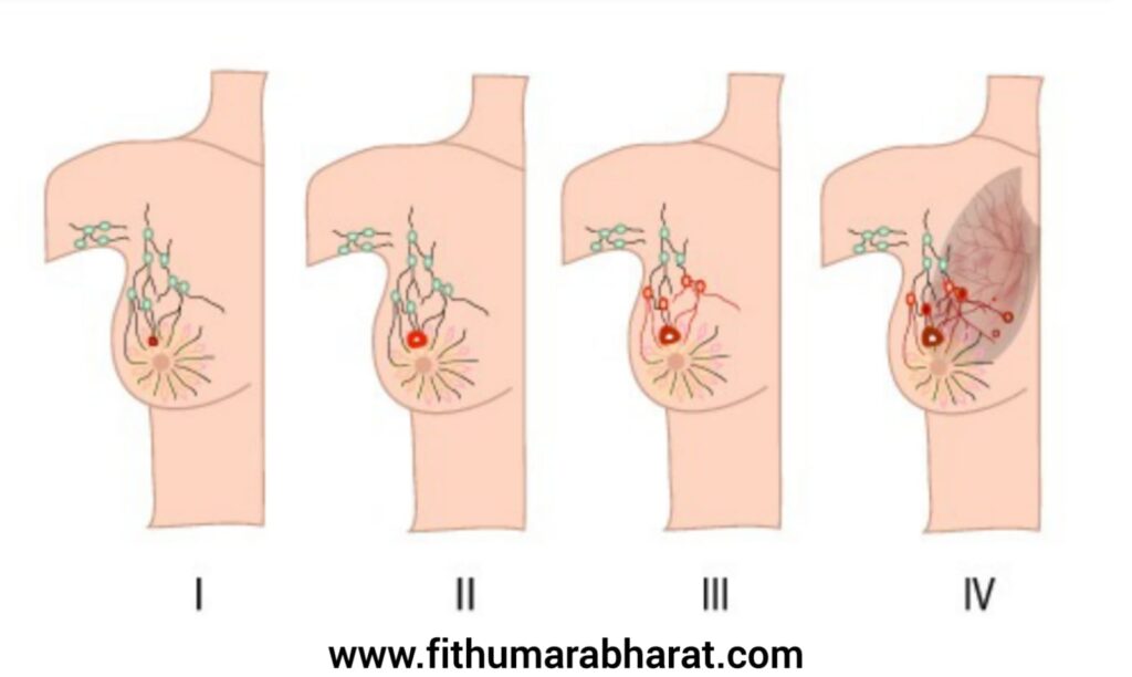 Breast Cancer stages_Fithumarabharat.com