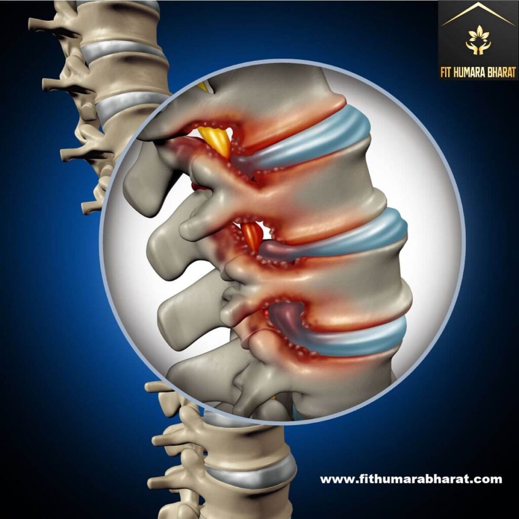 back pain because of Spinal Stenosis with fit humara bharat