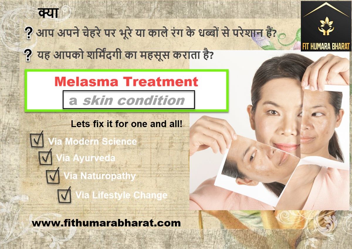 Melasma Treatment Fit Humara Bharat